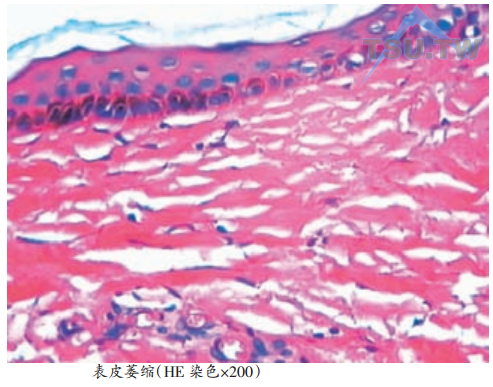 表皮萎缩
