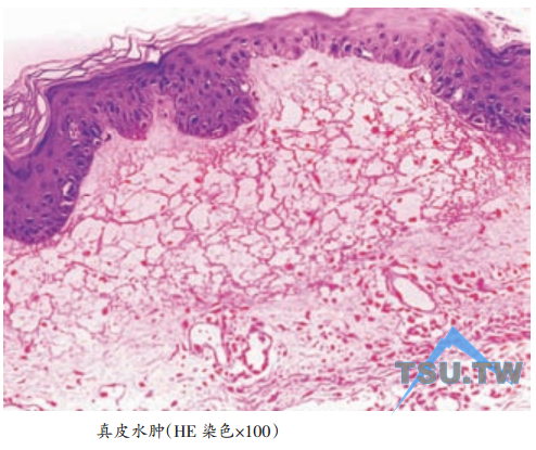 真皮水肿
