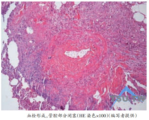 血管管腔闭塞及血栓形成