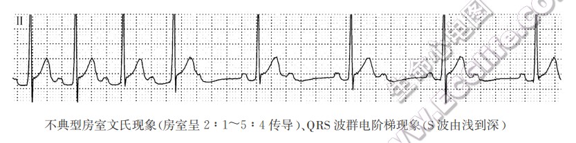 不典型房室文氏现象（心电图）