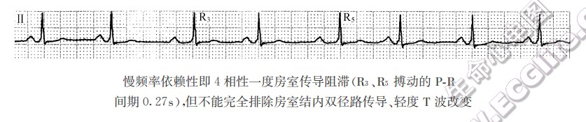 频率依赖性一度房室传导阻滞（心电图）