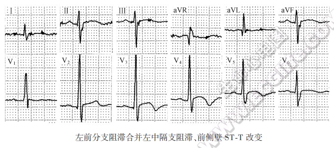 左前分支阻滞合并左中隔支阻滞、前侧壁ST-T改变（心电图）