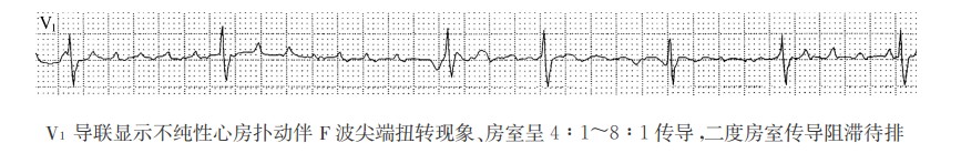 尖端扭转型心房扑动