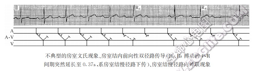 不典型的房室文氏现象、房室结内前向性双径路传导（心电图）