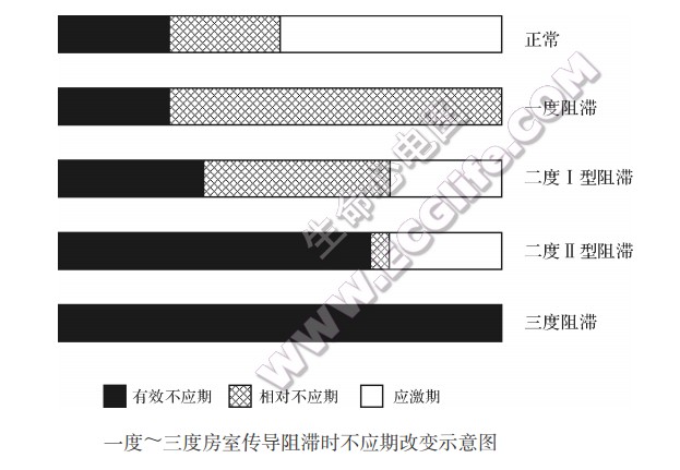 一度～三度房室传导阻滞时不应期改变示意图