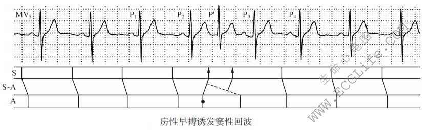 房性早搏诱发窦性回波(心电图)