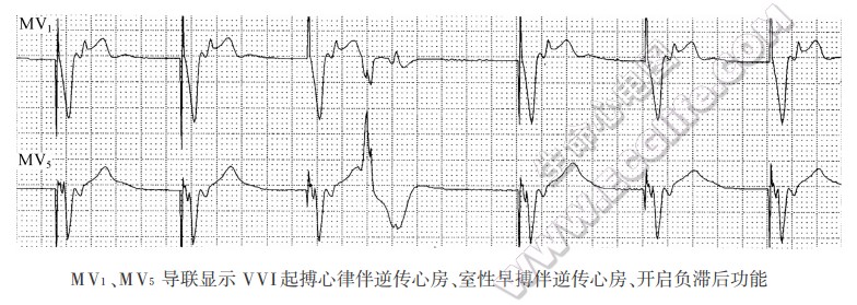 心脏起搏心电图常用的术语