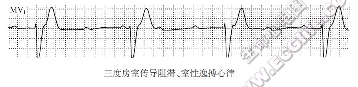 三度房室传导阻滞、室性逸搏心律（心电图）