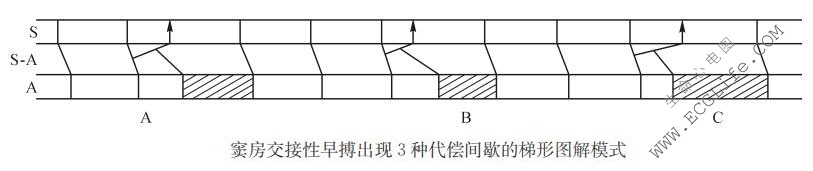 窦房交接性早搏