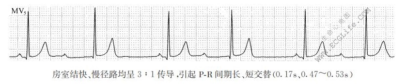 房室结快、慢径路均呈3:1传导