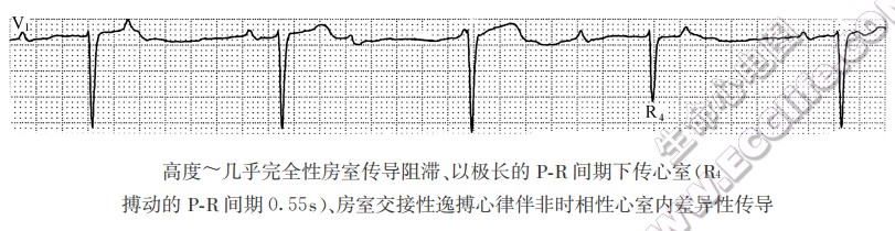 高度～几乎完全性房室传导阻滞（心电图）