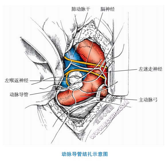 动脉导管未闭介入手术（动脉导管结扎示意图）