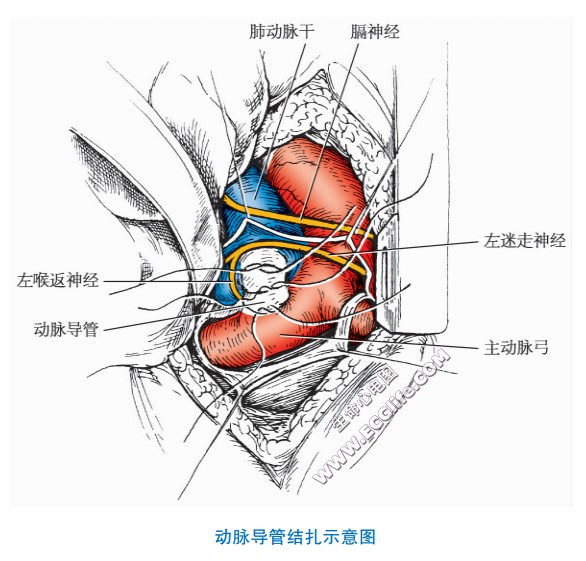 动脉导管未闭（PDA）的病理、诊断与治疗