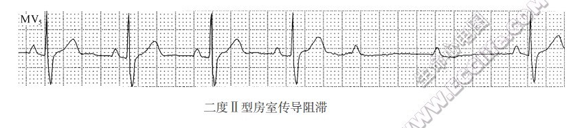 二度Ⅱ型房室传导阻滞（心电图）