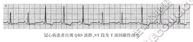 冠心病患者出现QRS波群、ST段及T波间歇性改变（心电图）