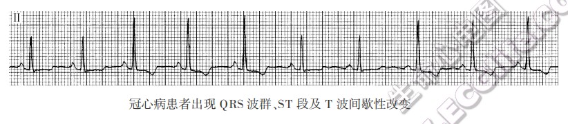 冠心病患者出现QRS波群、ST段及T波间歇性改变（心电图）
