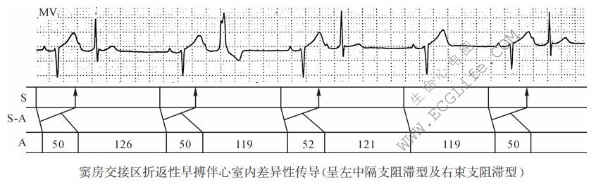 窦房交接区折返性早搏伴心室内差异性传导（心电图）