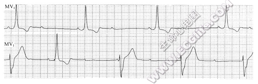 2：1或3：1二度房室传导阻滞（心电图）