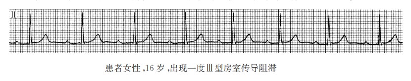 一度Ⅲ型房室传导阻滞（心电图）