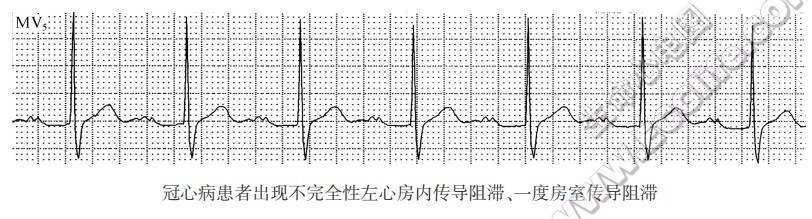 冠心病患者出现不完全性左心房内传导阻滞、—度房室传导阻滞（心电图）