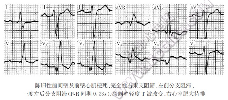 束支或分支阻滞与心肌梗死图形的并存与掩盖