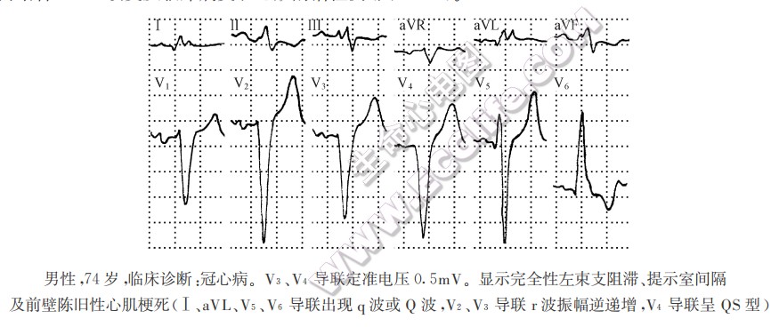 男性，74岁，临床诊断：冠心病。V3、V4导联定准电压0.5mV。显示完全性左束支阻滞、提示室间隔及前壁陈旧性心肌梗死（Ⅰ、aVL、Vs、V6导联出现q波或Q波，V2、V3导联r波振幅逆递增，V4导联呈QS型）（心电图）