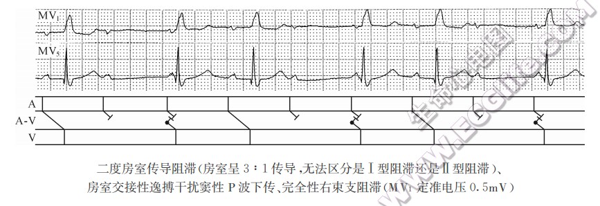 二度房室传导阻滞（心电图）