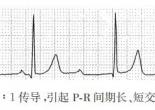 PR间期长、短交替