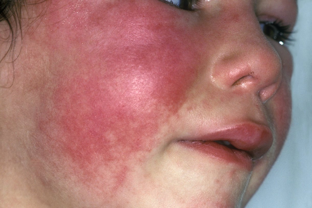 皮疹通常不会蔓延到脸上，但脸颊可能会变红