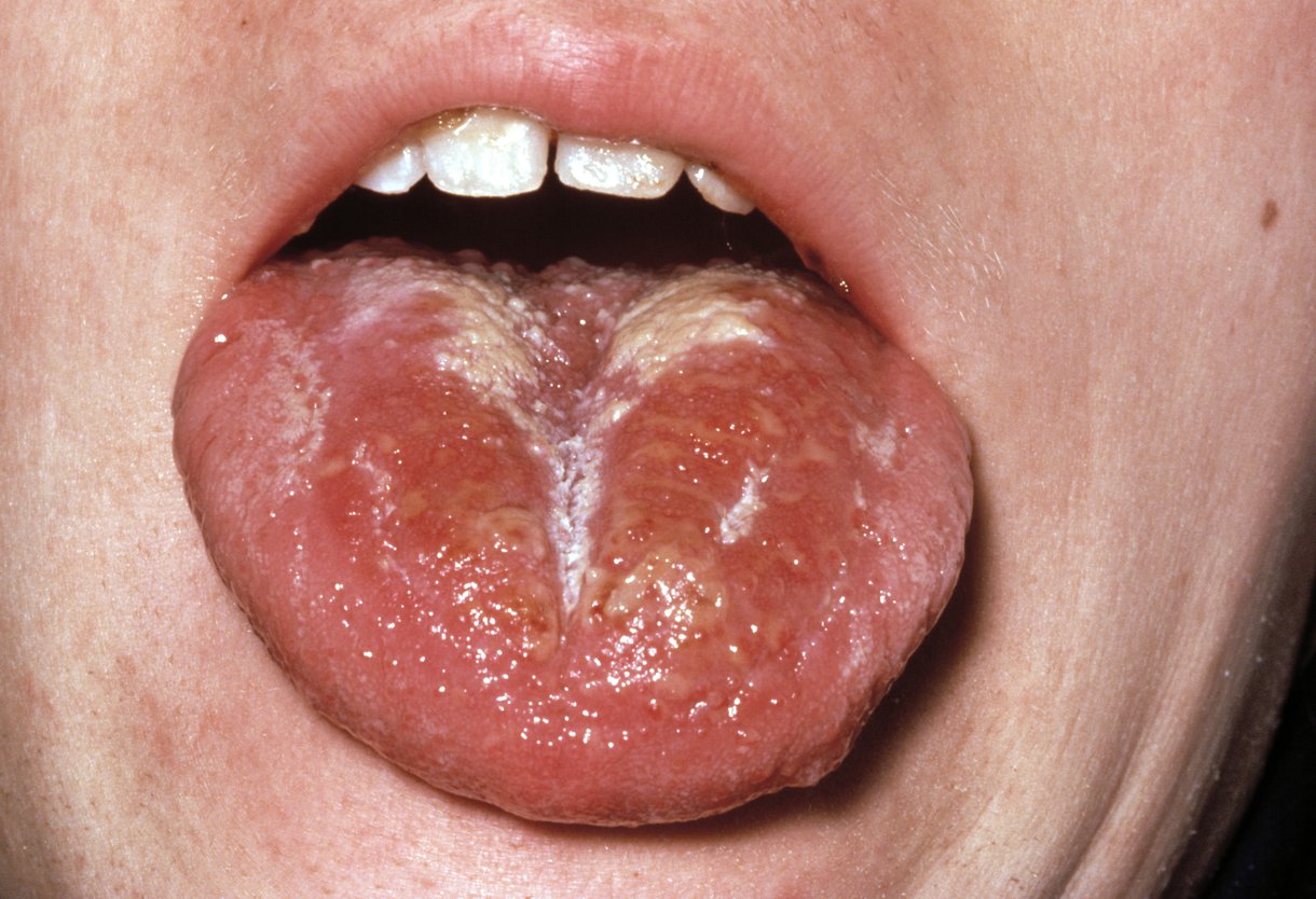 有时在舌头上会形成白色涂层。几天后会剥离，使舌头红肿。这被称为“草莓舌头”。