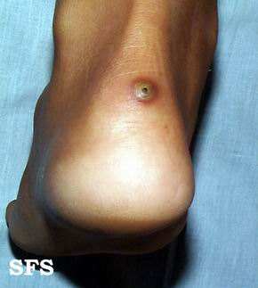 潜蚤病（沙蚤、钻潜蚤）的人体皮肤寄生