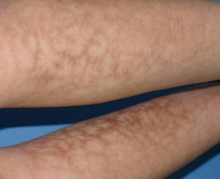 火激红斑（Erythema Ab Igne）