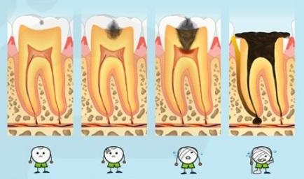 龋齿（蛀牙）流行病学及预防