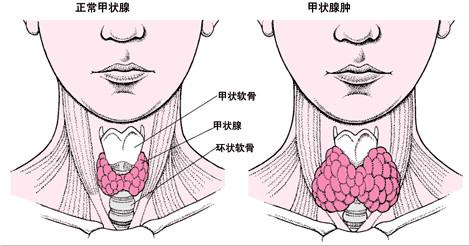 甲状腺肿大和甲状腺结节