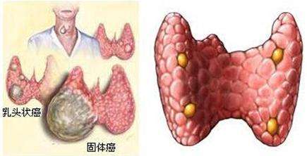 甲状腺肿瘤能治好吗？现行的治疗方法与病情追踪