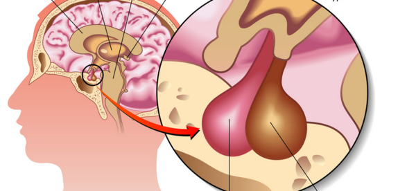 垂体瘤解读