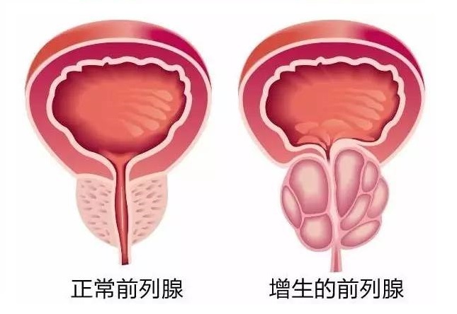 前列腺增生