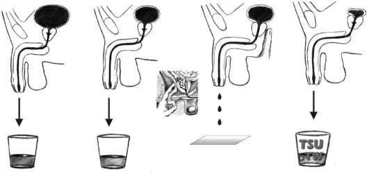 前列腺尿液四杯法检查示意图