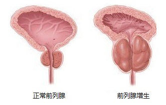 前列腺增生