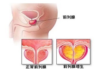 前列腺增生