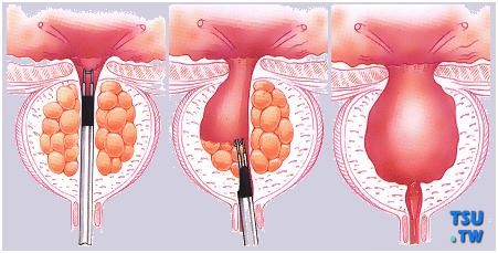 前列腺增生有哪些手术方式？