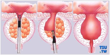前列腺增生手术
