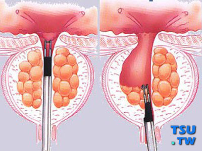前列腺增生手术治疗
