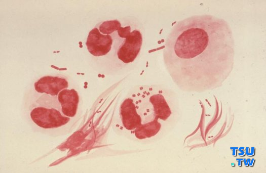 淋病患者淋球菌显微镜检查