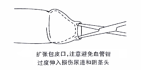 扩张包皮口，注意避免血管钳过度伸入损伤尿道和阴茎头