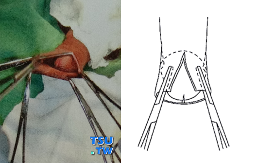 传统割包皮手术方法：剪刀法
