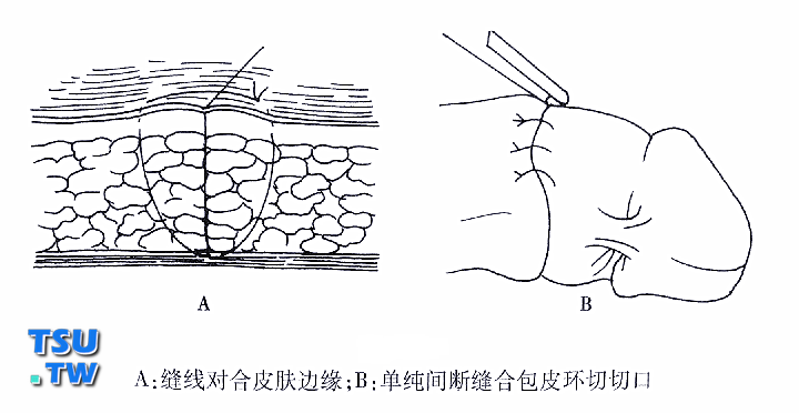 缝合对合皮肤边缘 淡出间断缝合包皮环切切口