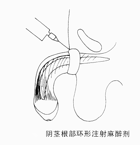 阴茎根部环形阻滞麻醉（割包皮手术麻醉法）