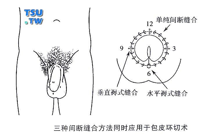 三种间断缝合方法同时应用于包皮环切术中