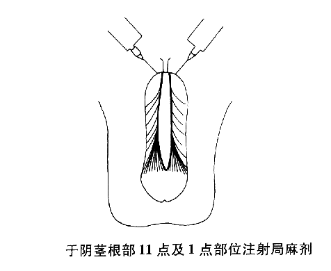 于阴茎根部11点击1点部位注射局麻剂